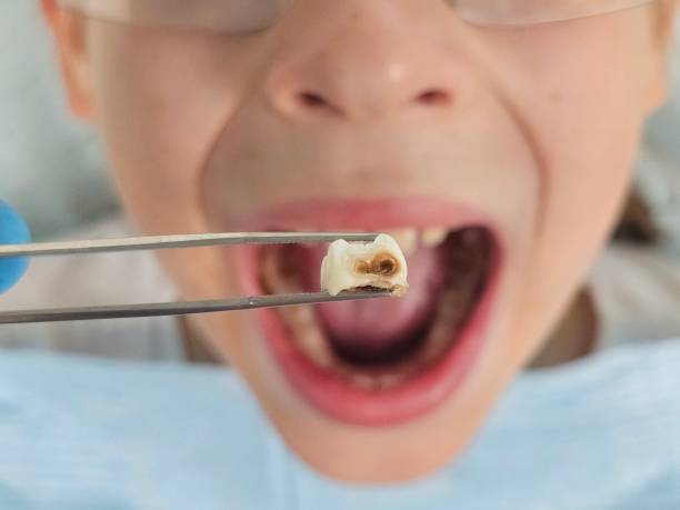 Best Dental Abscess Treatment in Suffern, NY