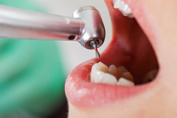 Best Emergency Wisdom Tooth Extraction in Suffern, NY